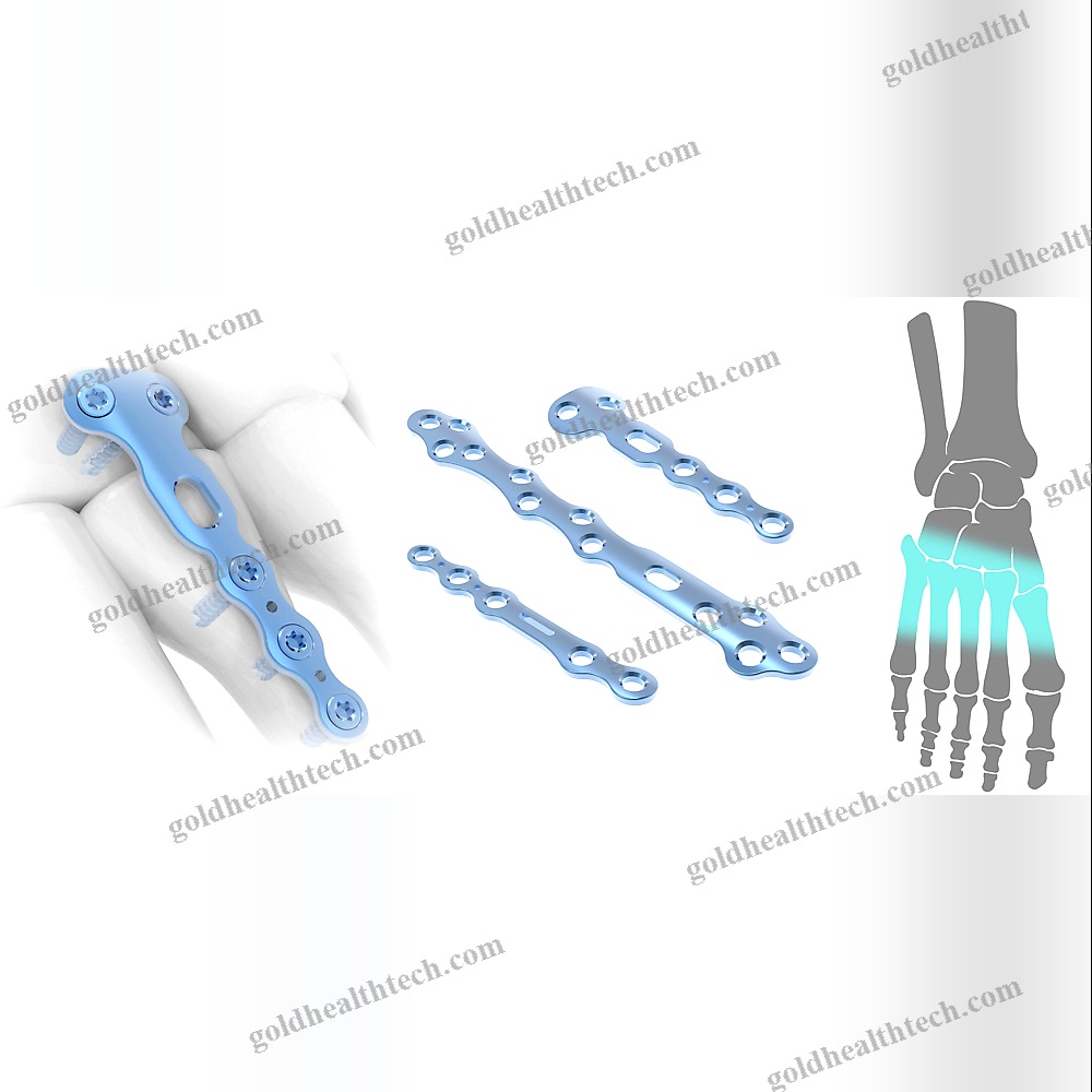 Tarso-Metatarsal Joint Arthrodesis Plate 1