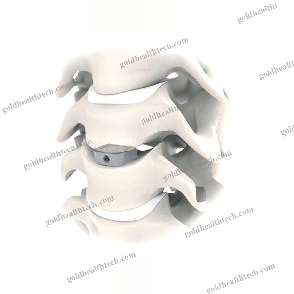 Thoraco-Lumbar Interbody Fusion Cage 1