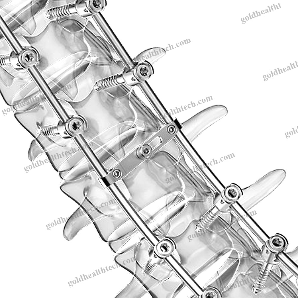 Thoraco-Lumbar Osteosynthesis Unit