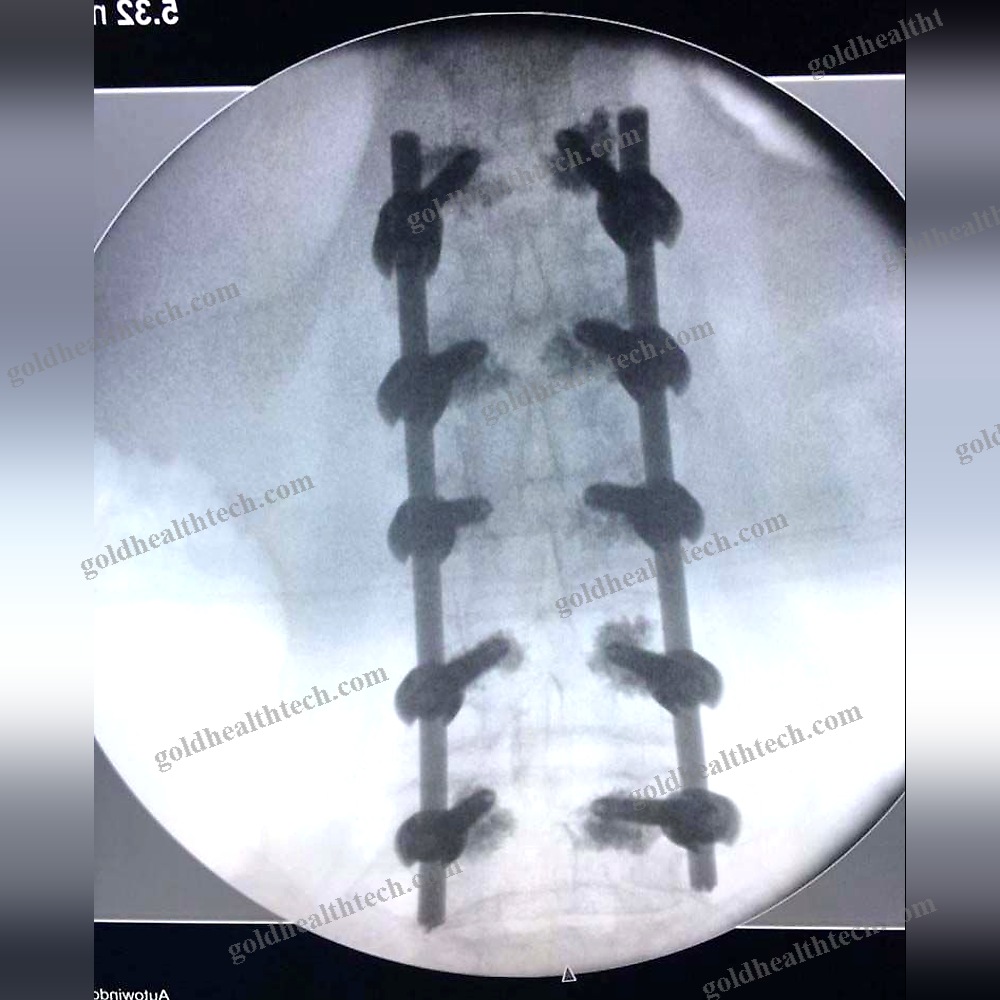 Thoraco-Lumbar Pedicle Screw 1