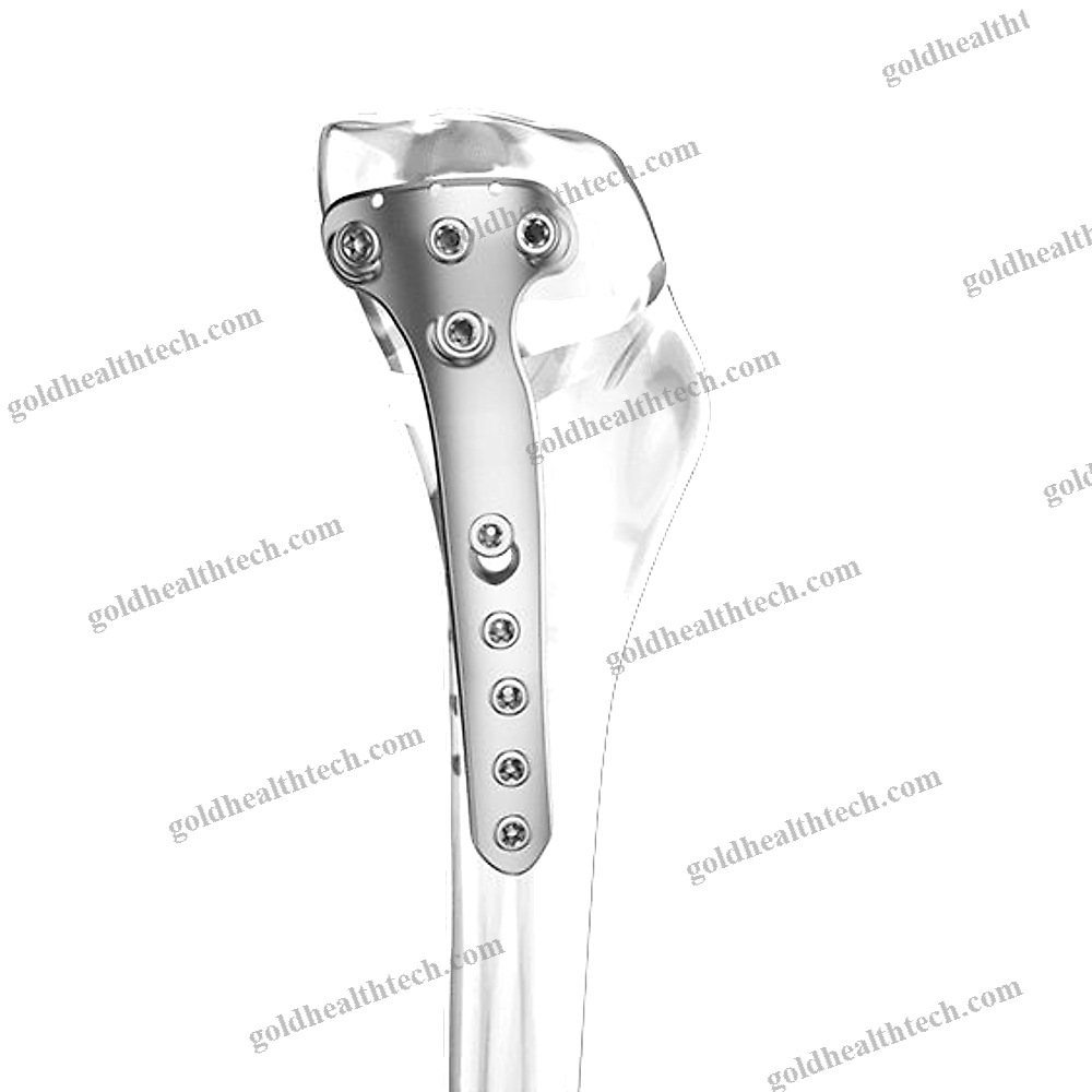 Tibia Osteotomy Plate
