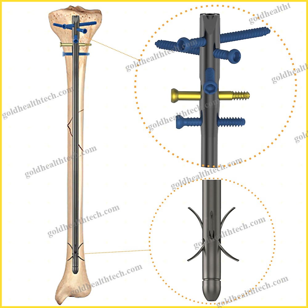 Tibial Intramedullary Nail 1