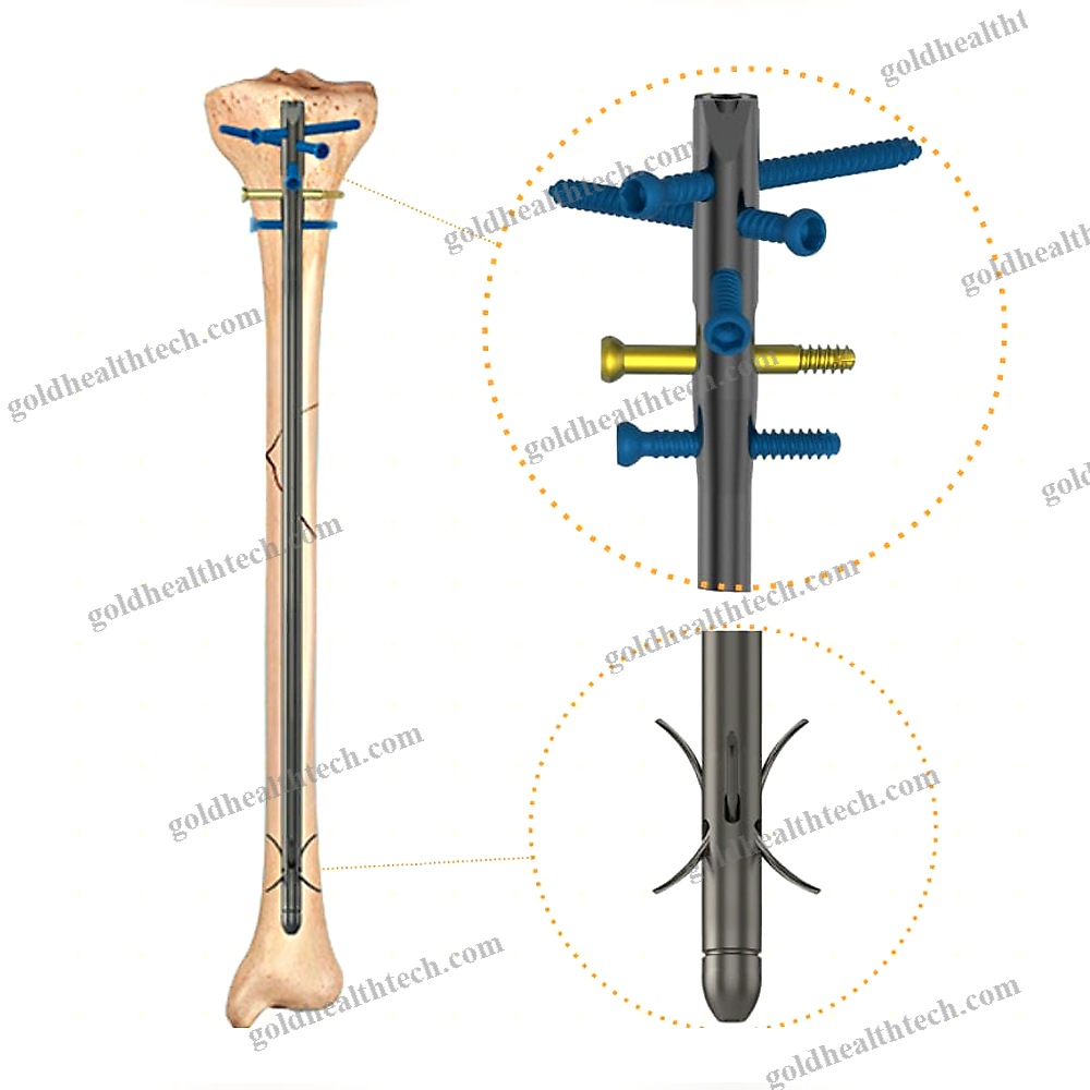 Tibial Intramedullary Nail