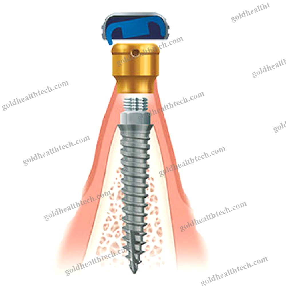 Titanium Dental Implant