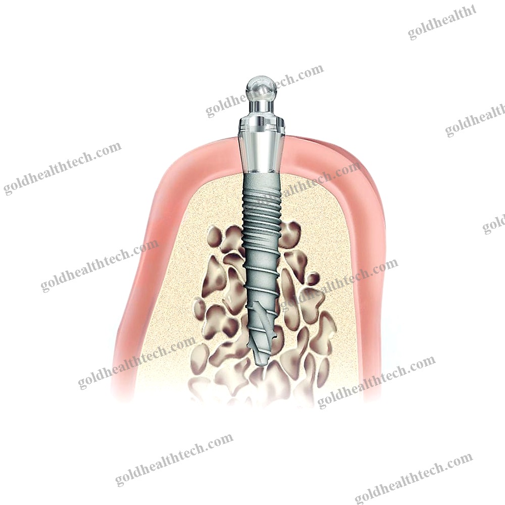 Titanium Dental Implant