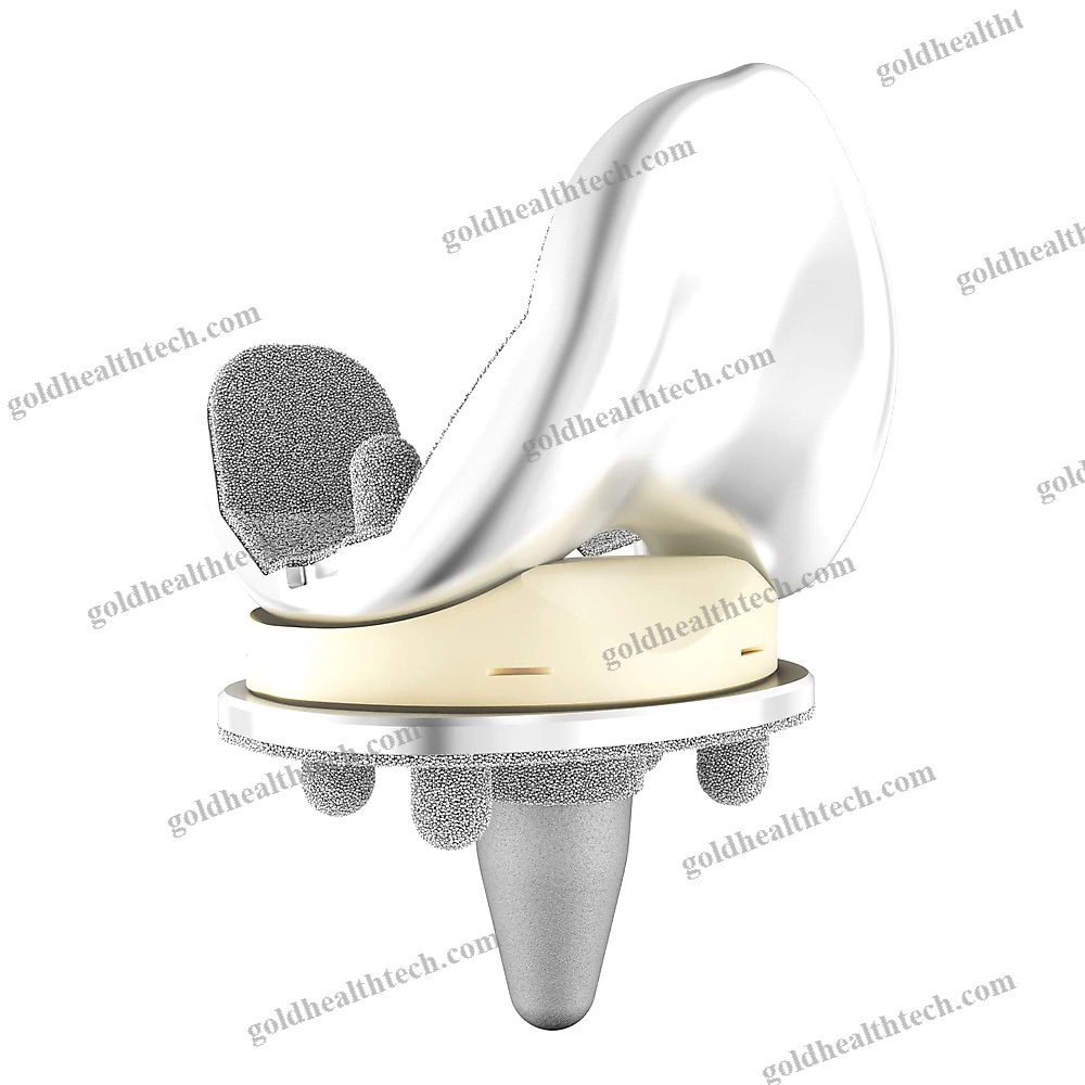 Total Knee Prosthesis 1