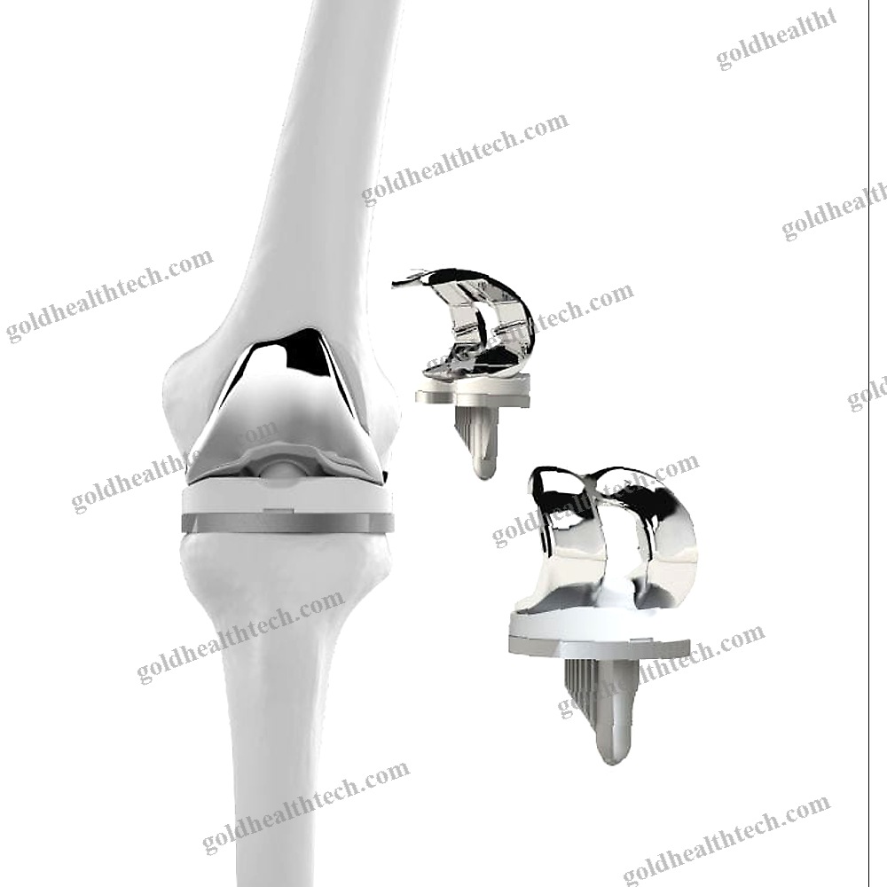 Total Knee Prosthesis
