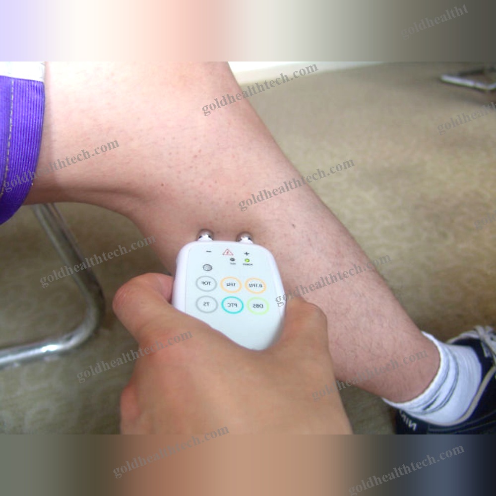 Transcutaneous Neurostimulator