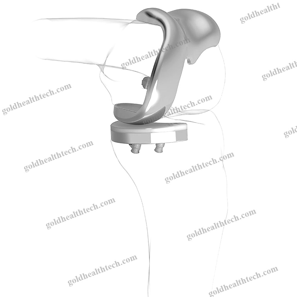 Unicompartmental Knee Prosthesis